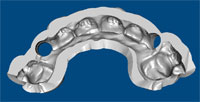 Dental Implant - Drill Guide Design